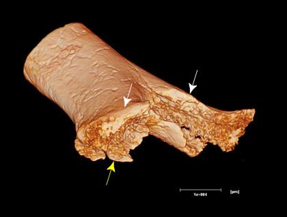  une amputation vieille de 7 000 ans