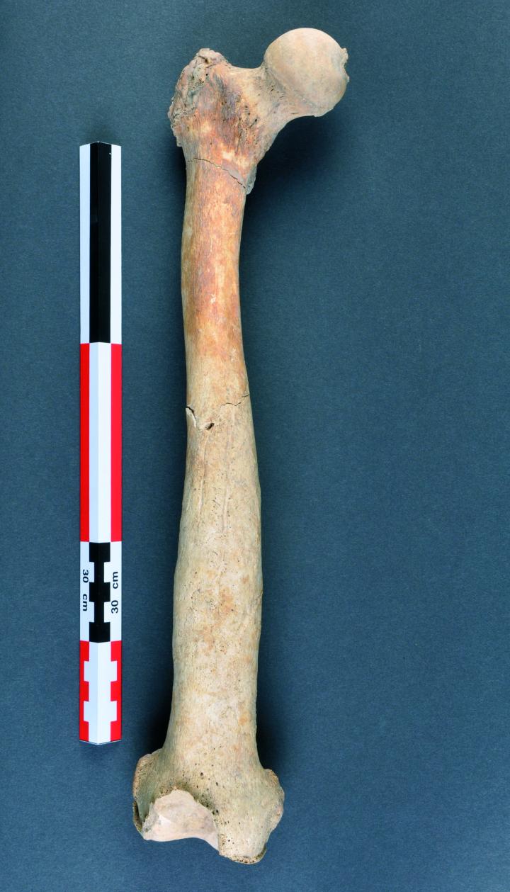 Fémur droit en vue antérieure(fait 161) montrant une probable ostéomyélite de la métaphyse distale