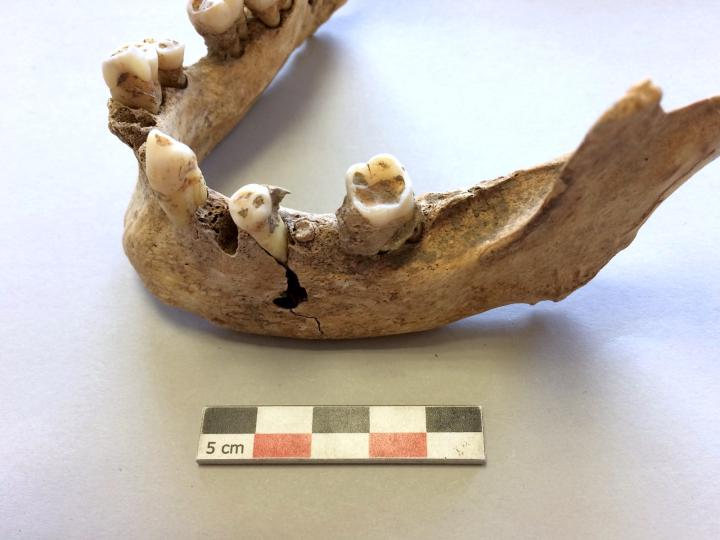 Exemple de mauvaise hygiène bucco-dentaire. Exemple de mauvaise hygiène bucco-dentaire.