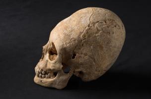 Crâne volontairement déformé mis au jour dans une nécropole du Bas-Empire à Obernai (Bas-Rhin), 2013.  Au Ve s. de notre ère, cette pratique est d'abord associée aux Huns, célèbre groupe ethnique d'Asie centrale. Cette pratique permet à une élite de se di