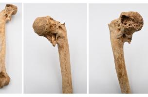 Fracture ancienne de l’humérus gauche observée chez le sujet masculin de la sépulture 979