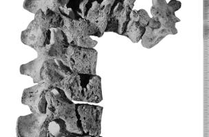 exemple de tuberculose vertébrale, le mal de Pott exemple de tuberculose vertébrale, le mal de Pott
